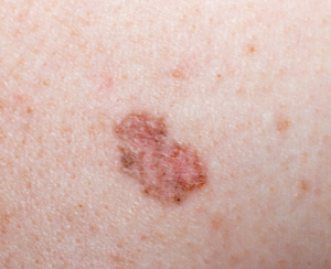 Skin Cancer Images