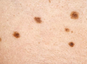 Skin Cancer Images