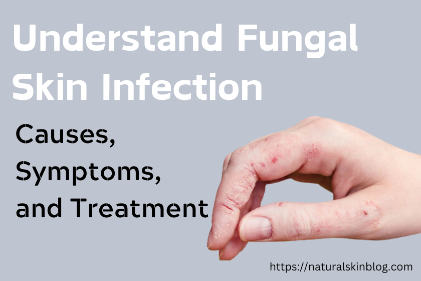 Fungal Skin Infection