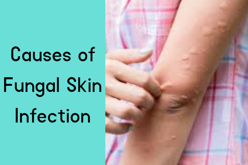 Fungal Skin Infection Causes