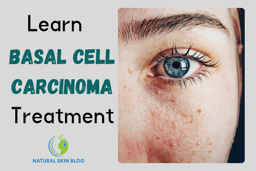 Basal Cell Carcinoma Treatment