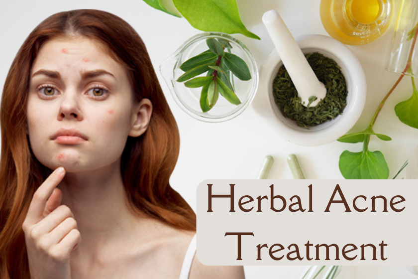 Herbal Acne Treatment